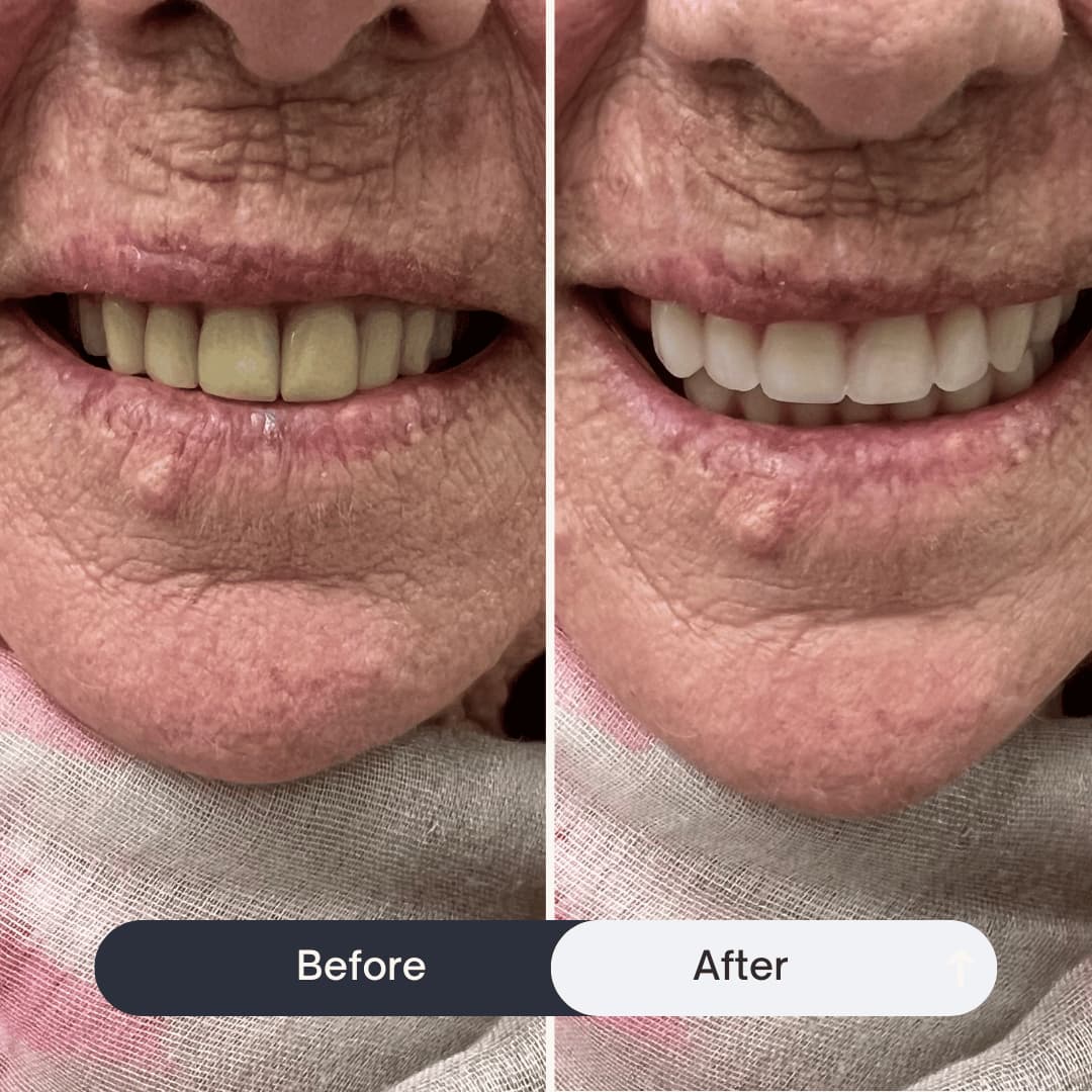 Before and After of Alpha Garde Brisbane Mobile Denture Clinic