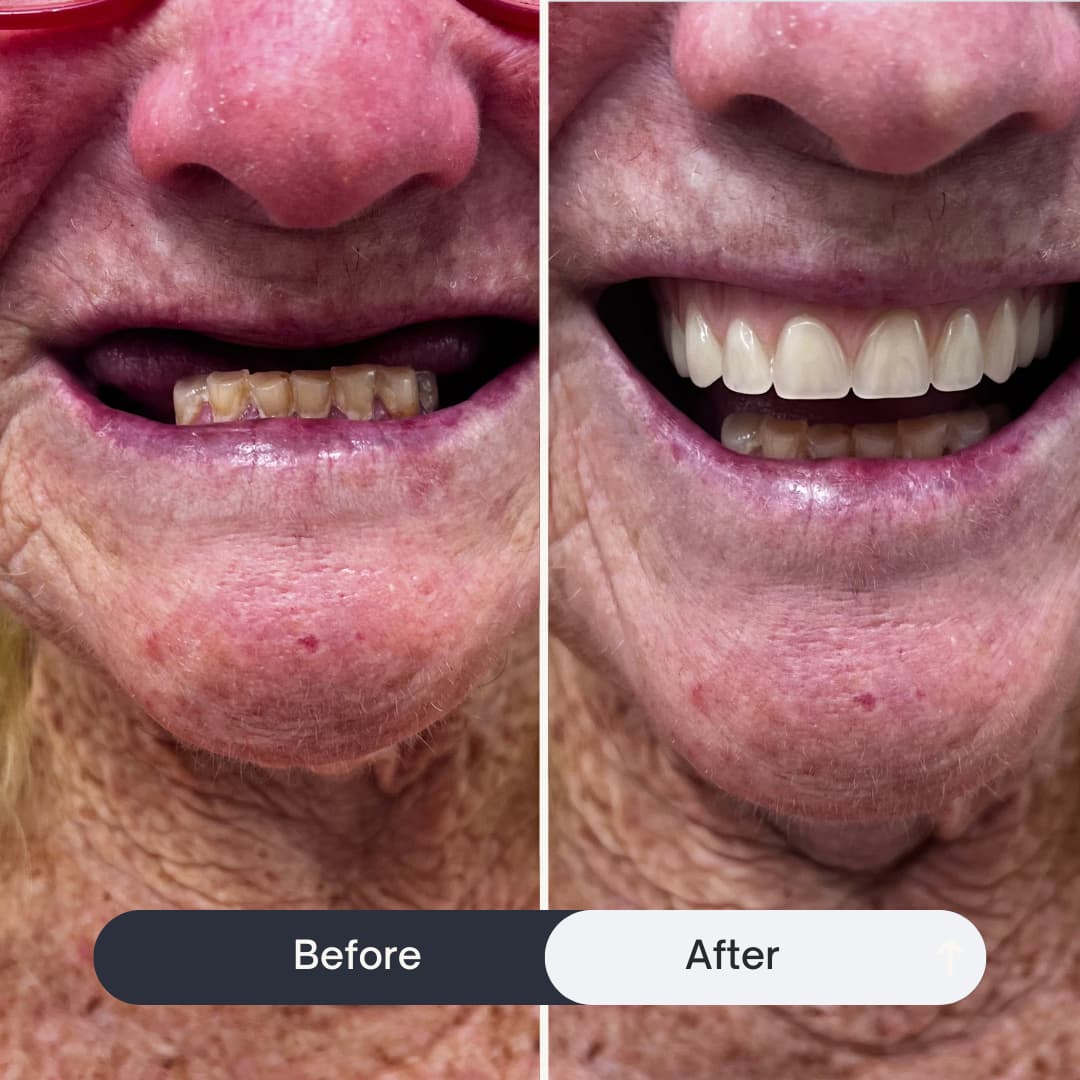 Before and After of Alpha Garde Brisbane Mobile Denture Clinic