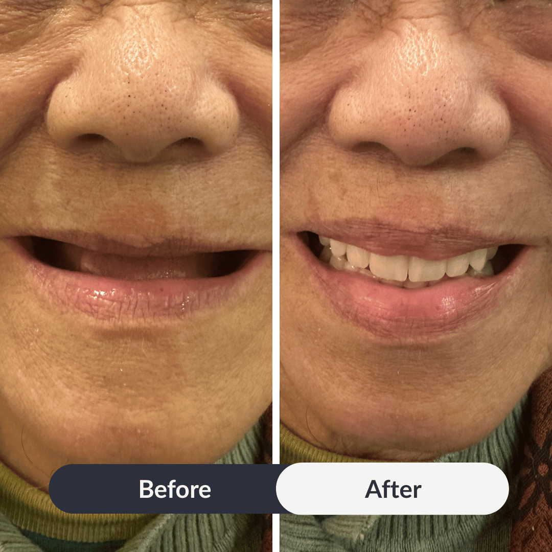 Before and After of Alpha Garde Brisbane Mobile Denture Clinic
